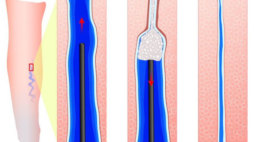 Склеротерапия: эффективная процедура при своевременном обращении