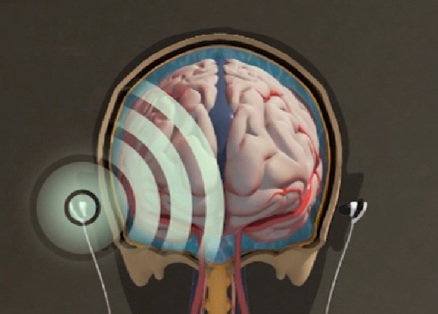 Пара наушников снижает внутричерепное давление